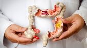 این ادویه راه نجات از سرطان روده 