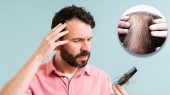 علت ریزش موی سکه‌ای را بدانید/ این بیماری چگونه درمان کنم؟