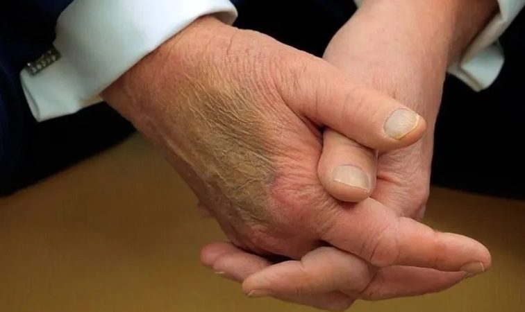 نام بیماری دونالد ترامپ فاش شد 