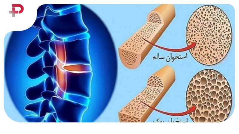 پوکی استخوان از چه سنی شروع می شود؟