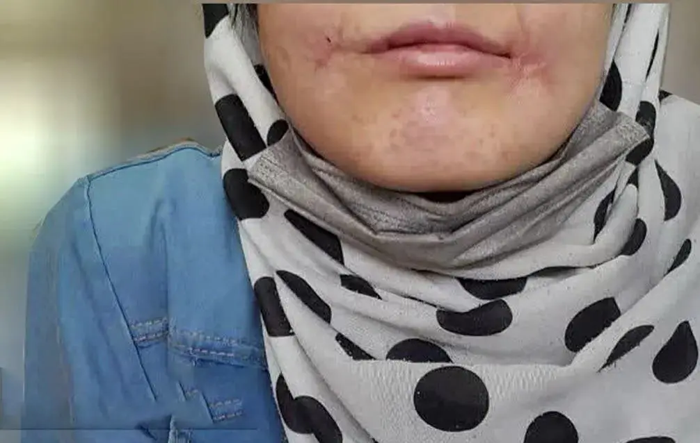 شوهر معتاد لب‌های همسر ۱۸ ساله‌اش را با نخ و سوزن دوخت