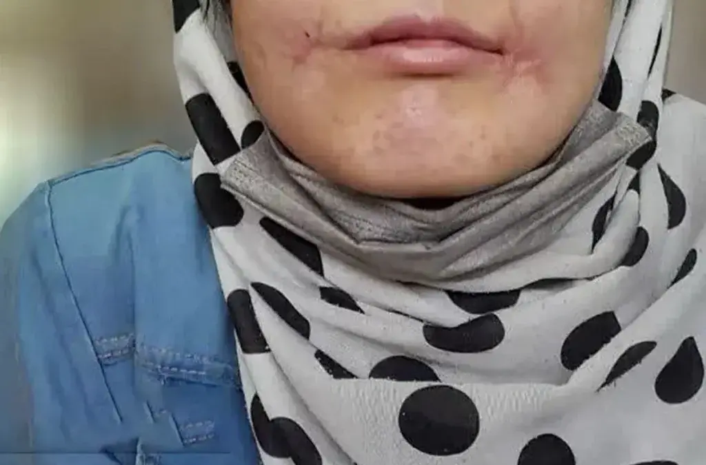 روایت تکان‌دهنده زن جوان از یک سال شکنجه در مشهد: شوهرش لب‌هایش را با نخ و سوزن دوخت!