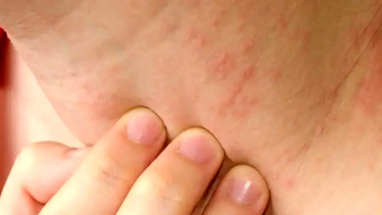 عرق‌ سوزی را دست‌کم نگیرید / اشتباهات ساده‌ای که التهاب پوست را تشدید می‌ کند - تصویر شاخص